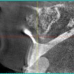 zahngesundheit im loretto, implantat, Zahnimplantate, Zähne, Implantologie, Tübingen, Ausschnitt
