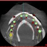 zahngesundheit im loretto, implantat, Zahnimplantate, Zähne, Implantologie, Tübingen, Ausschnitt