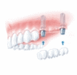 Zahngesundheit im Loretto Tübingen - Implantologie, Zähne, Zahnimplantate, Implantologe, Implantation - Brücke auf zwei Implantaten