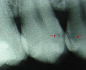 Zahngesundheit im loretto, implantat, Zahnimplantate, Zähne, Implantologie, Tübingen, Röntgen, Zwischenraumkaries, Zähne
