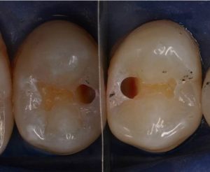 Zahngesundheit im loretto, implantat, Zahnimplantate, Zähne, Implantologie, Tübingen, Kariesentfernung, Zähne