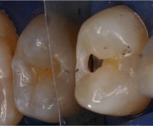 Zahngesundheit im loretto, implantat, Zahnimplantate, Zähne, Implantologie, Tübingen, Kariesentfernung, Zähne
