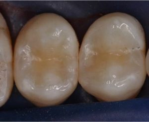 Zahngesundheit im loretto, implantat, Zahnimplantate, Zähne, Implantologie, Tübingen, Fertigstellung, Kariesentfernung, Zähne