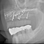 zahngesundheit im loretto, implantat, Zahnimplantate, Zähne, Implantologie, Tübingen, Aufbau