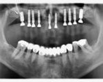 zahngesundheit im loretto, implantat, Zahnimplantate, Zähne, Implantologie, Tübingen, OPG