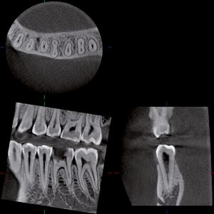 röntgengeräten, digitales röntgen, zähne, Zahngesundheit im loretto, implantat, Zahnimplantate, Zähne, Implantologie, Tübingen